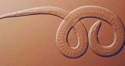 Family Reunion Left 3 People Hospitalized With Rare Parasitic Worms, CDC Reports